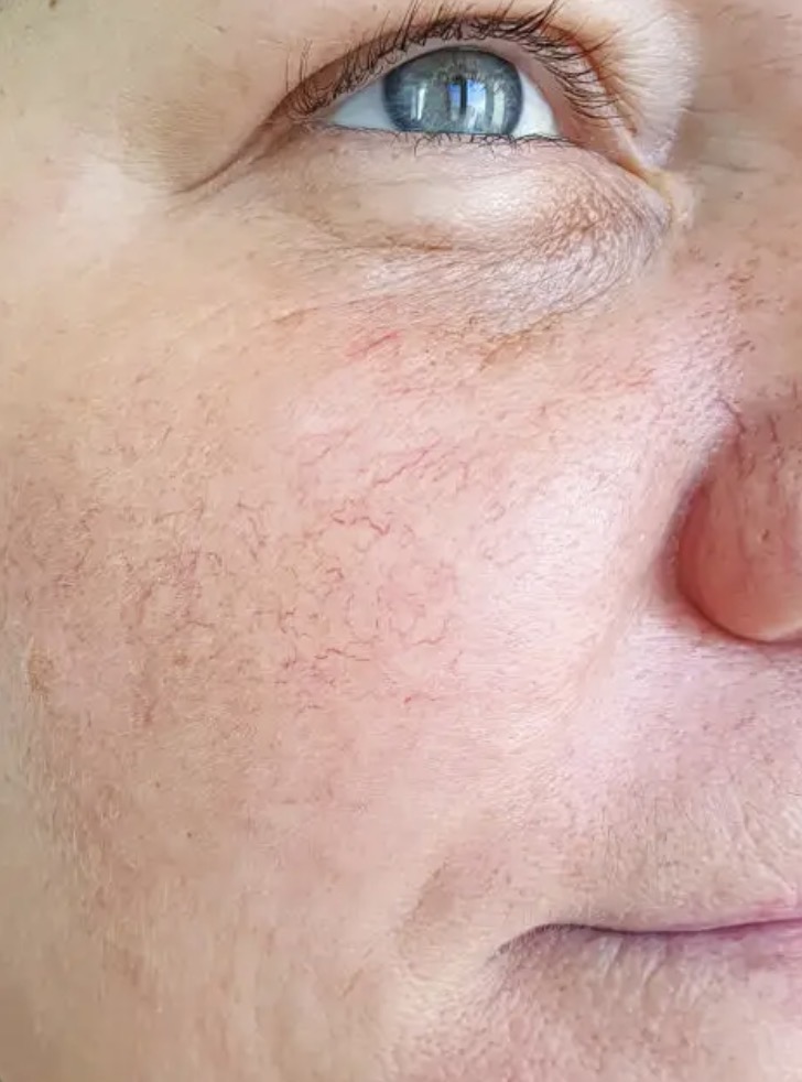 Couperose rode adertjes beautyvit huidverbetering breda