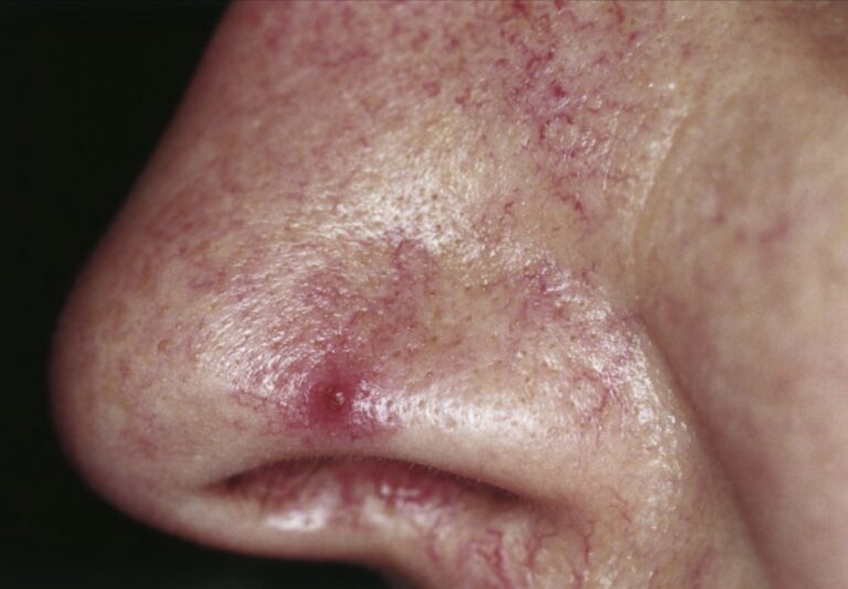 Spider naevus adertje gesprongen adertje Beautyvit Huidverbetering Breda