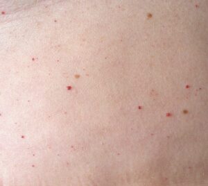 Kersenangioom gesprongen adertje rood vlekje