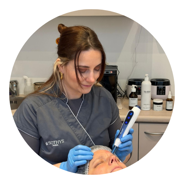 Denise microneedling