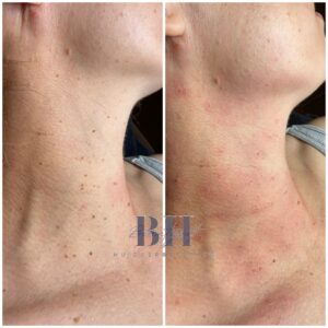 Huidwoekeringen huidoneffenheden Beautyvit Huidverbetering Breda