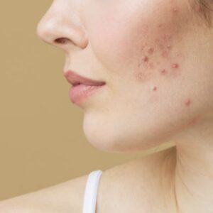 Acne / Vette huid